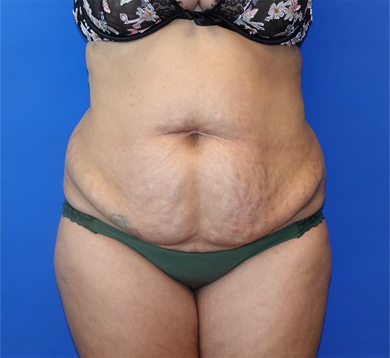 Body Contouring Before & After Photo