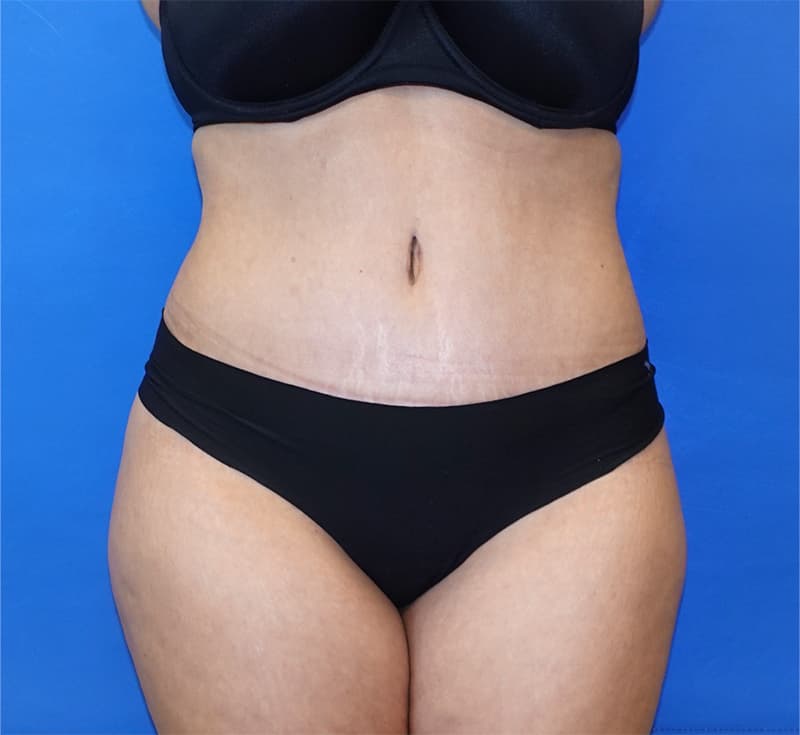 Body Contouring Before & After Photo