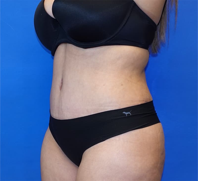 Body Contouring Before & After Photo