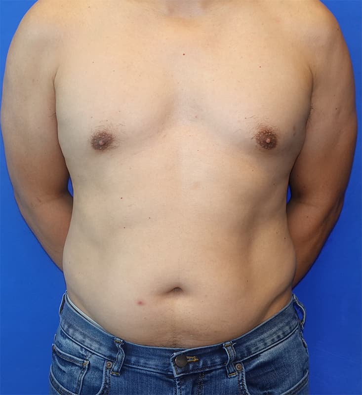 Liposuction Before & After Photo