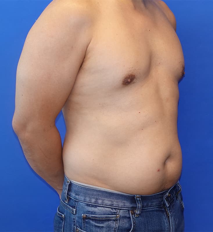 Liposuction Before & After Photo