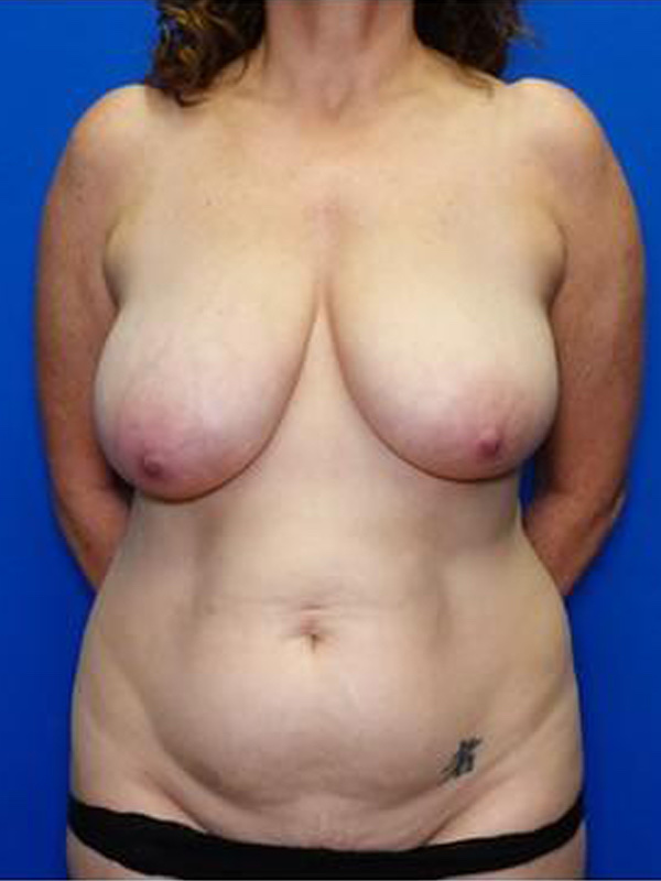 Liposuction Before & After Photo