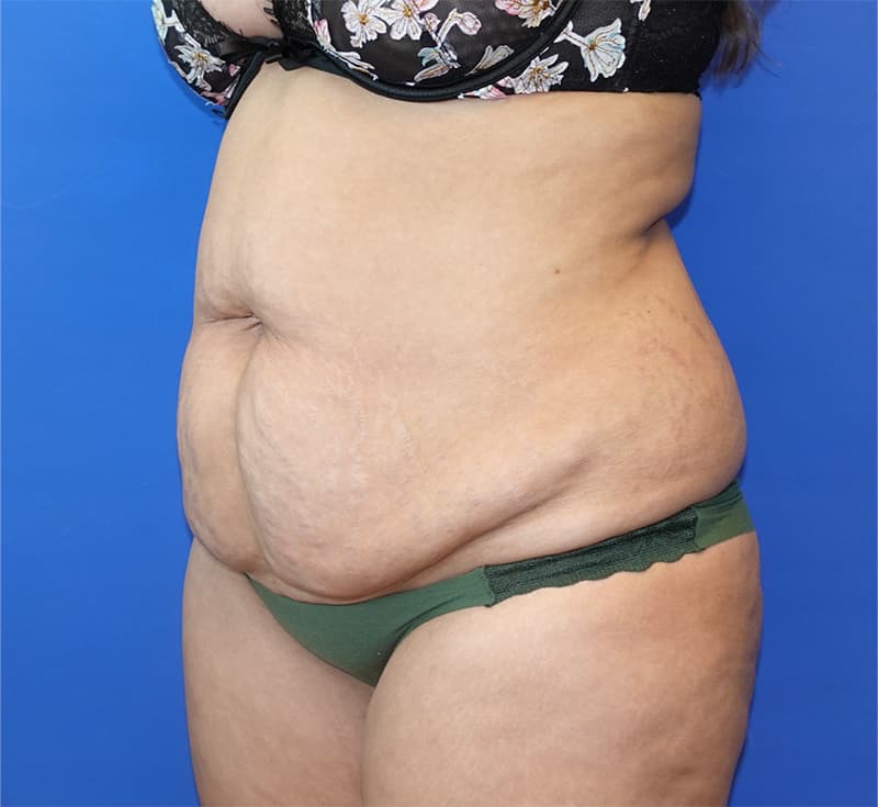 Liposuction Before & After Photo