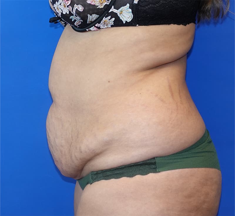 Liposuction Before & After Photo