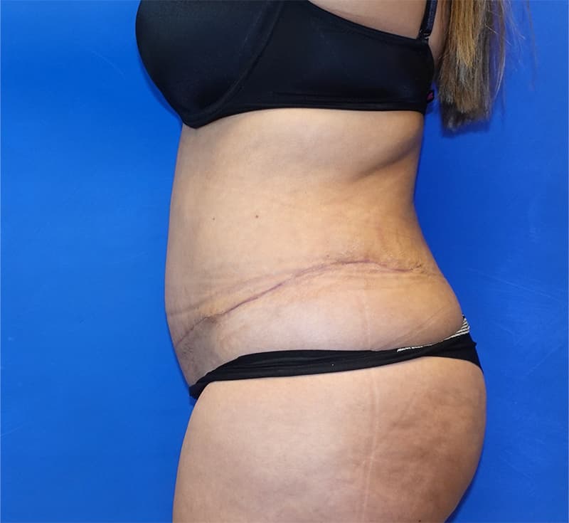 Liposuction Before & After Photo