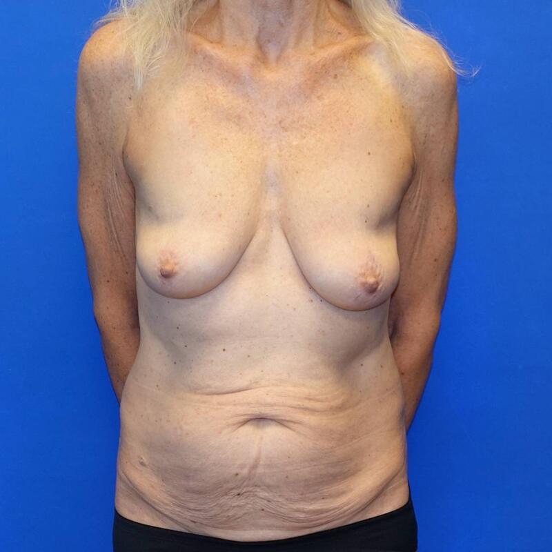 Tummy Tuck Before & After Photo