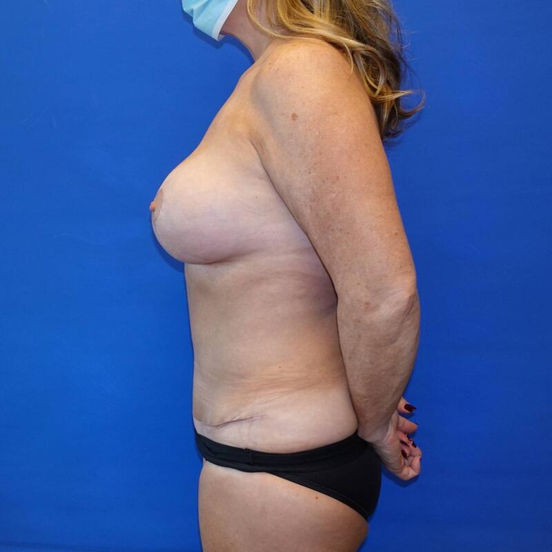 Tummy Tuck Before & After Photo