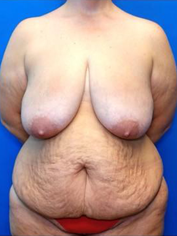 Tummy Tuck Before & After Photo