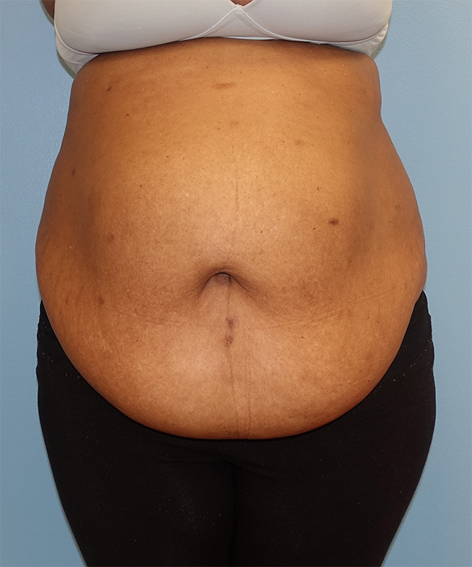 Tummy Tuck Before & After Photo