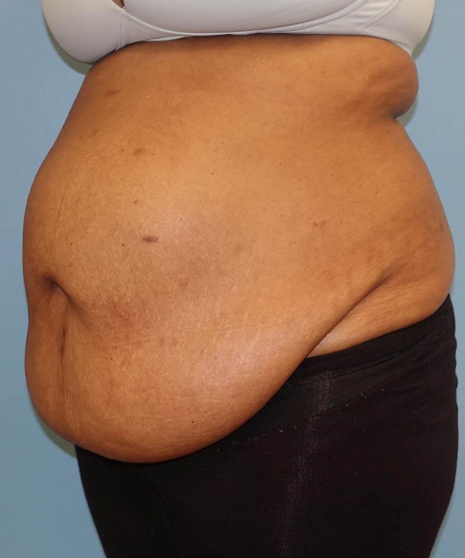 Tummy Tuck Before & After Photo