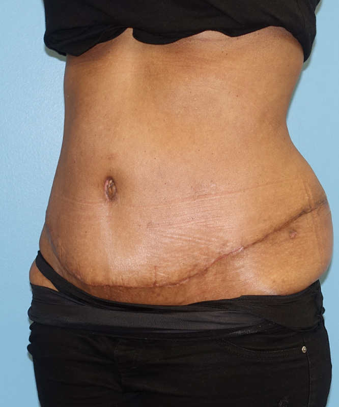 Tummy Tuck Before & After Photo