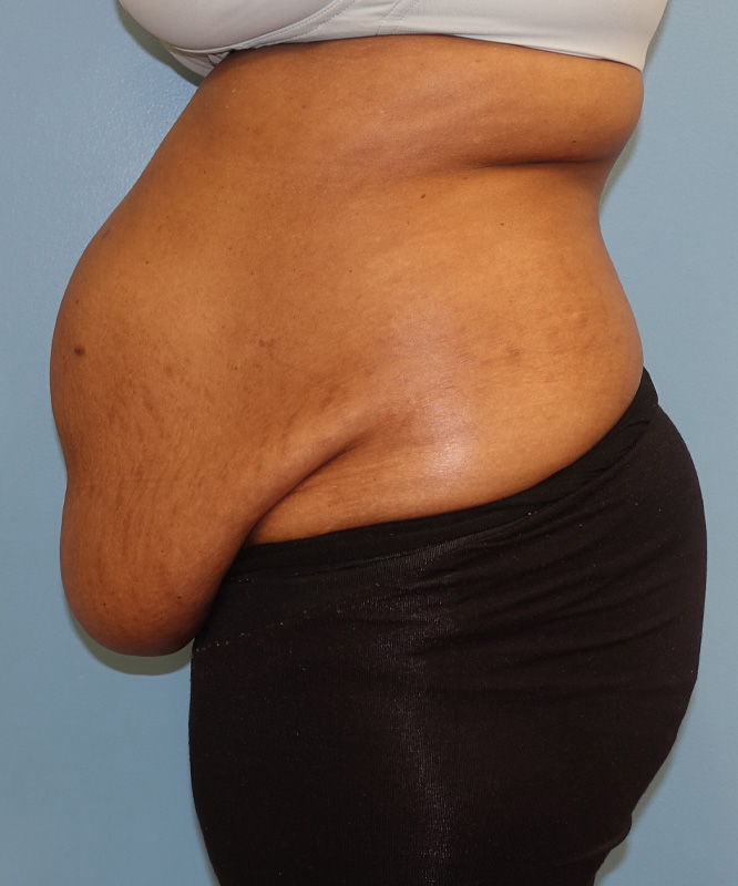 Tummy Tuck Before & After Photo