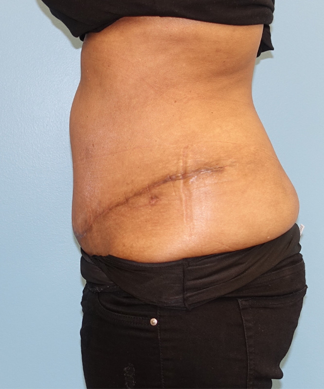 Tummy Tuck Before & After Photo