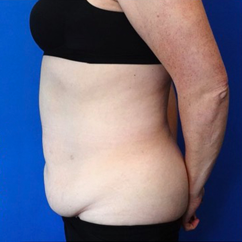 Tummy Tuck Before & After Photo