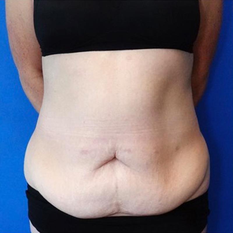 Tummy Tuck Before & After Photo