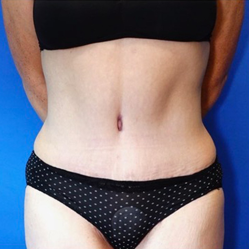 Tummy Tuck Before & After Photo