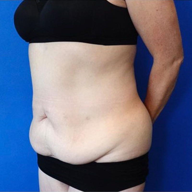 Tummy Tuck Before & After Photo