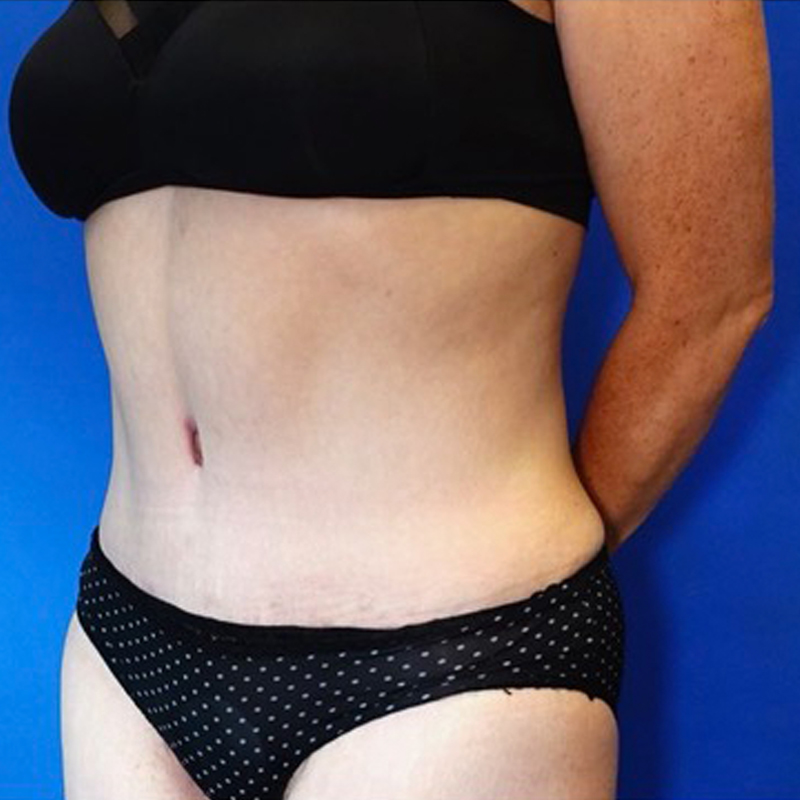 Tummy Tuck Before & After Photo
