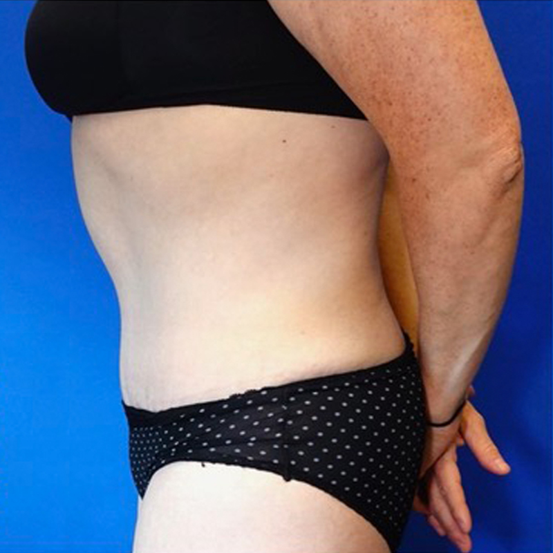 Tummy Tuck Before & After Photo