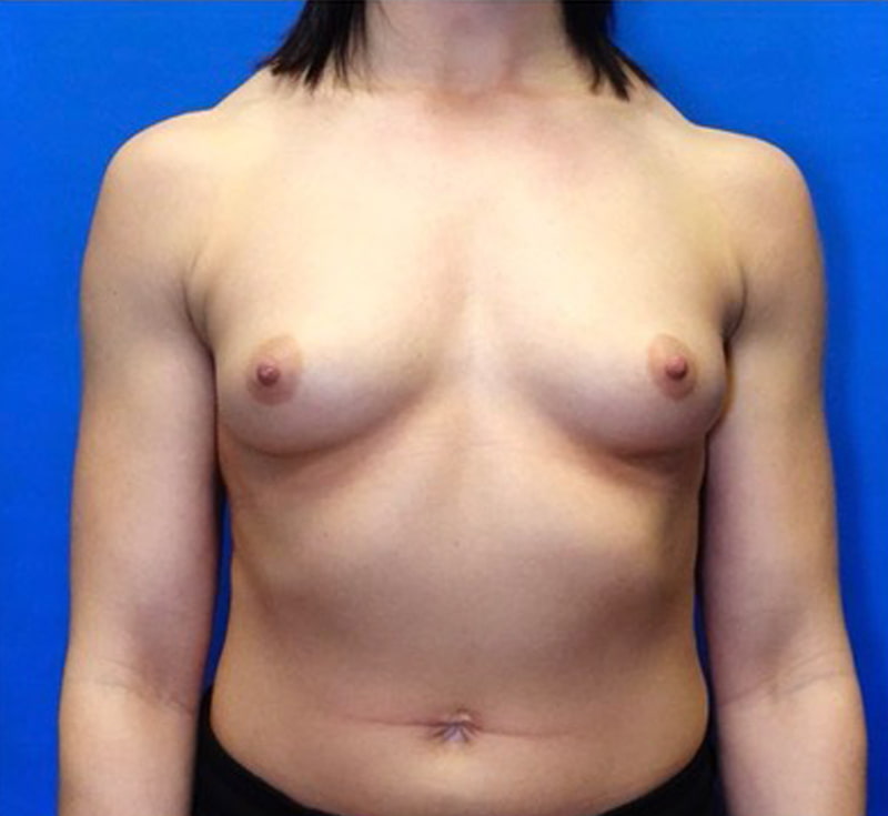 Breast Augmentation Before & After Photo