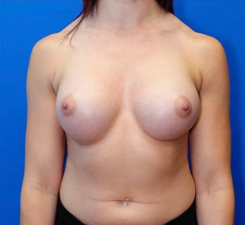 Breast Augmentation Before & After Photo