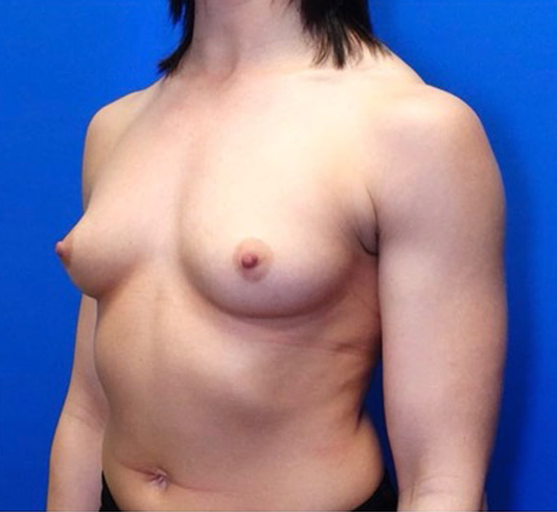 Breast Augmentation Before & After Photo