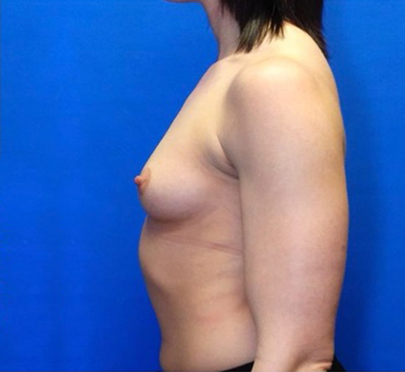 Breast Augmentation Before & After Photo
