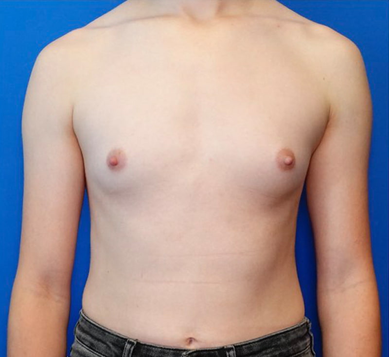 Breast Augmentation Before & After Photo