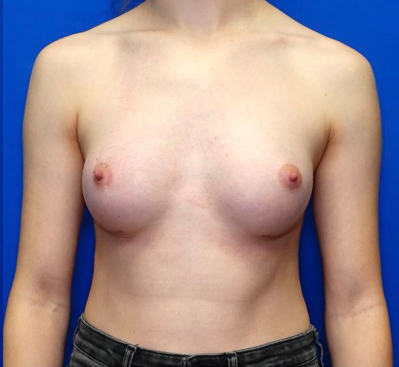 Breast Augmentation Before & After Photo