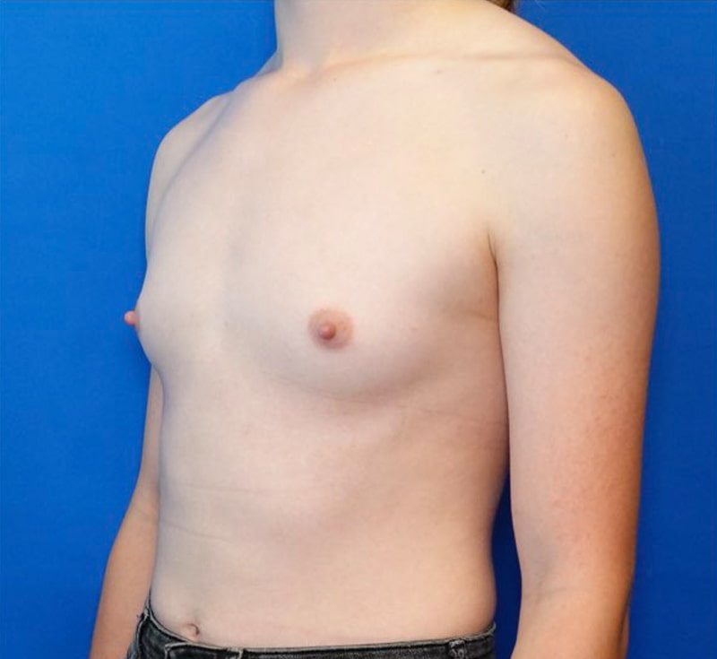 Breast Augmentation Before & After Photo