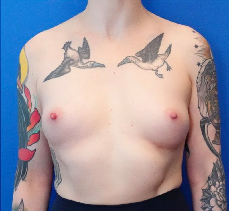 Breast Augmentation Before & After Photo