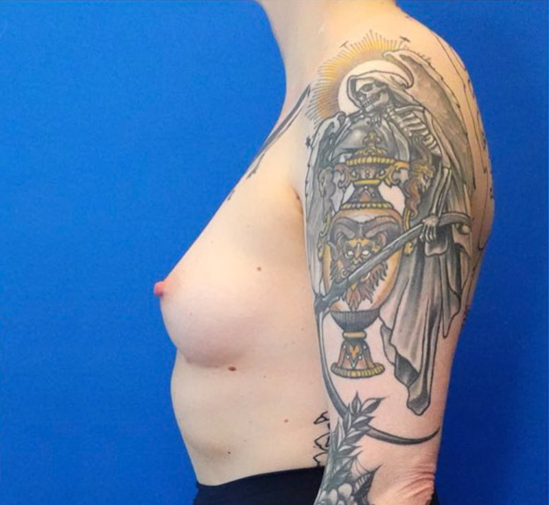 Breast Augmentation Before & After Photo