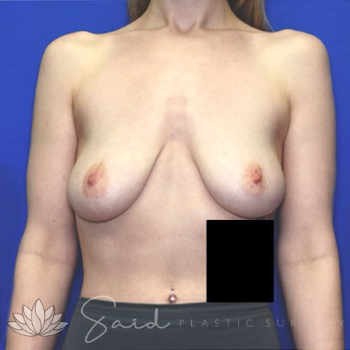 Breast Augmentation Before & After Photo