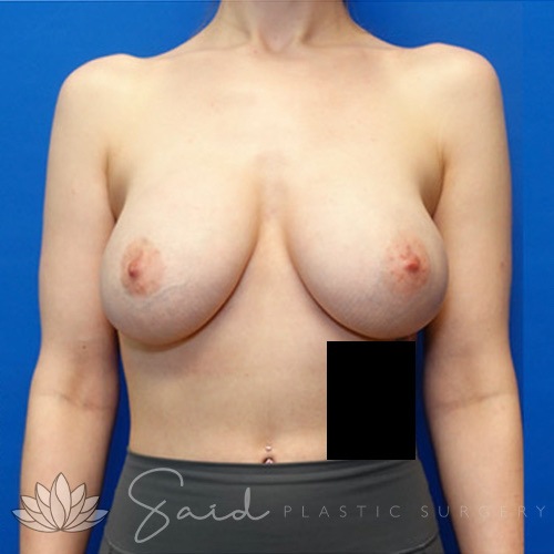 Breast Augmentation Before & After Photo