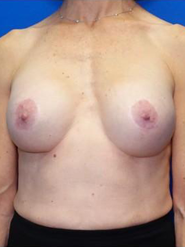 Breast Implant Exchange Before & After Photo