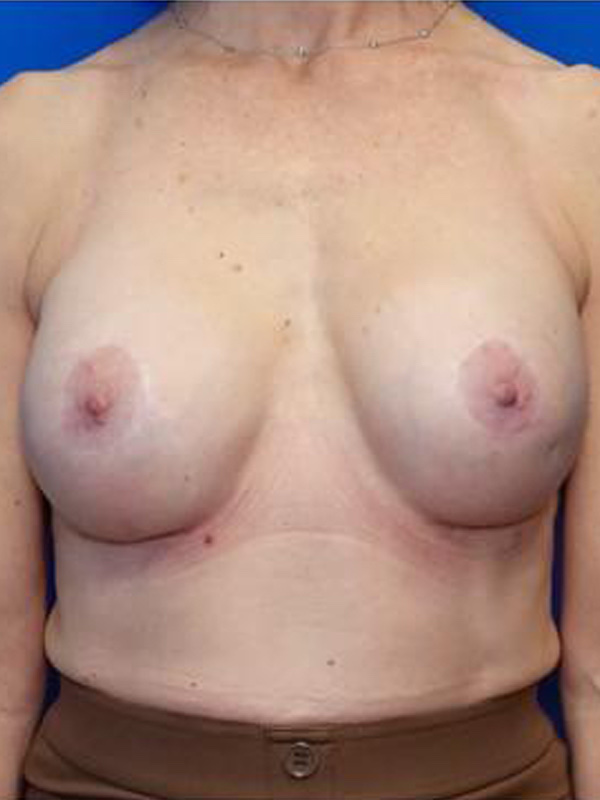 Breast Implant Exchange Before & After Photo