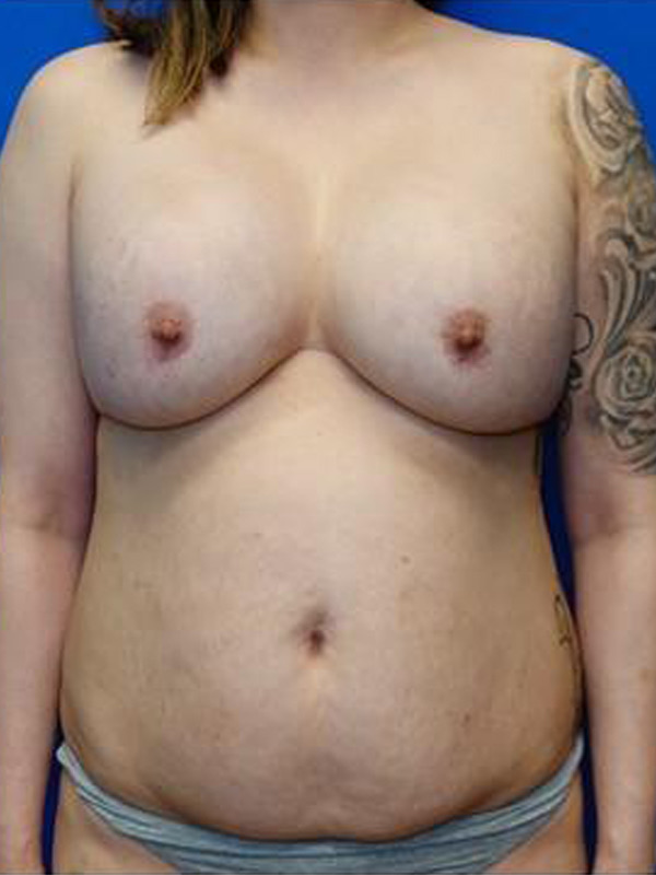Breast Implant Exchange Before & After Photo