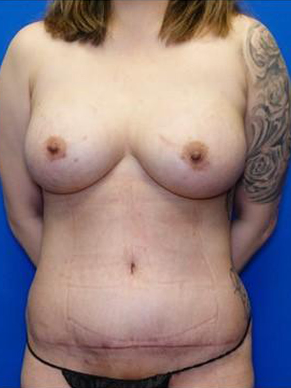 Breast Implant Exchange Before & After Photo