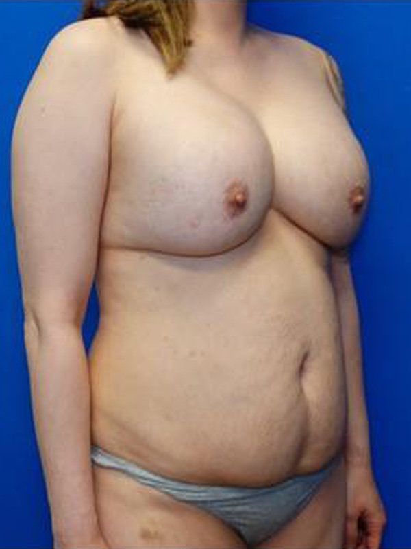 Breast Implant Exchange Before & After Photo