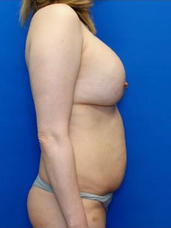 Breast Implant Exchange Before & After Photo