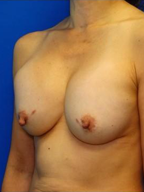 Breast Implant Exchange Before & After Photo