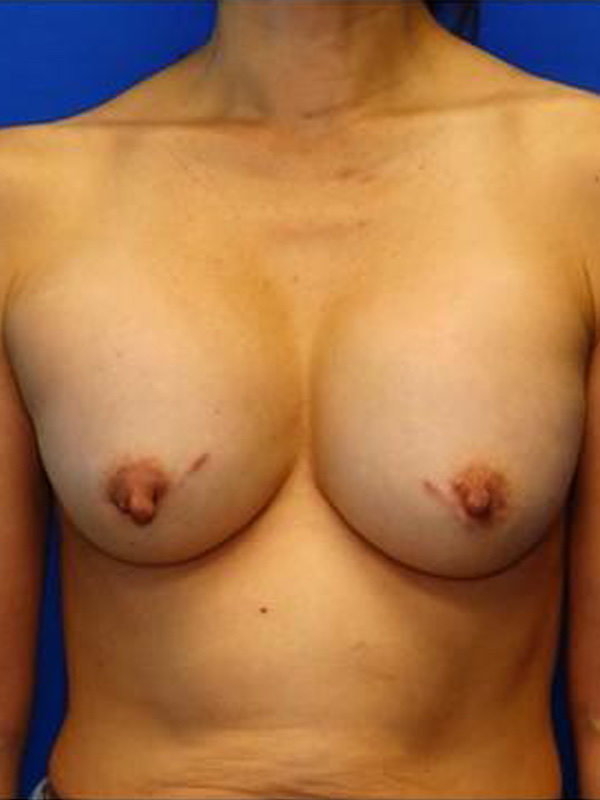 Breast Implant Exchange Before & After Photo