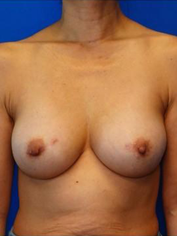 Breast Implant Exchange Before & After Photo