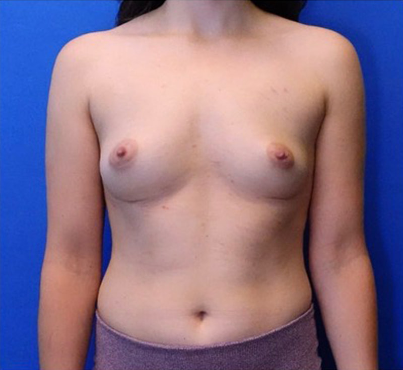 Breast Implant Removal Before & After Photo