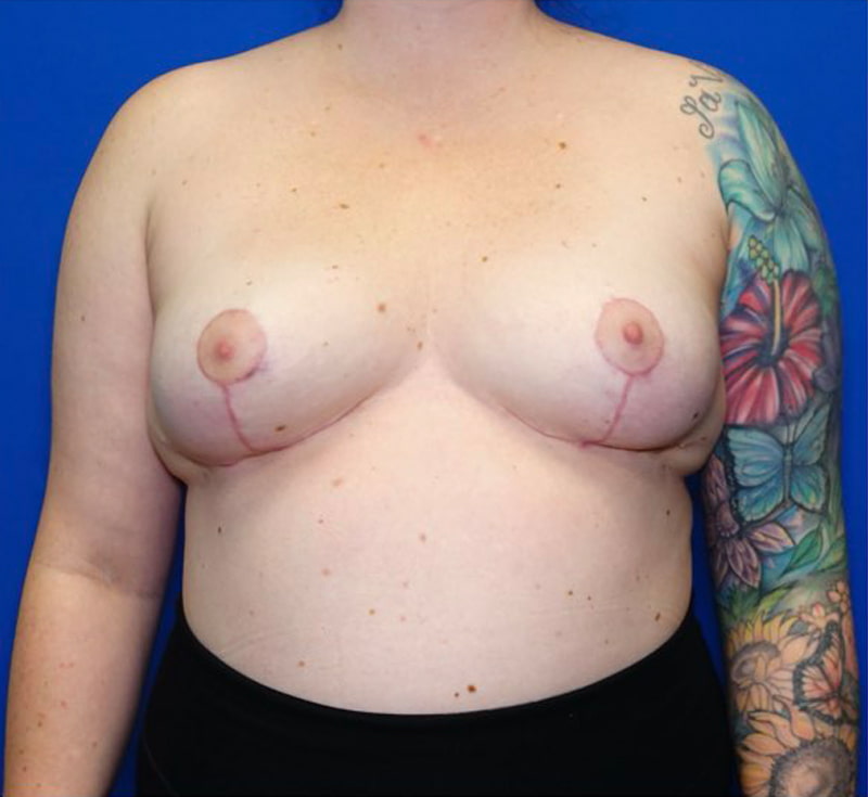 Breast Implant Removal Before & After Photo