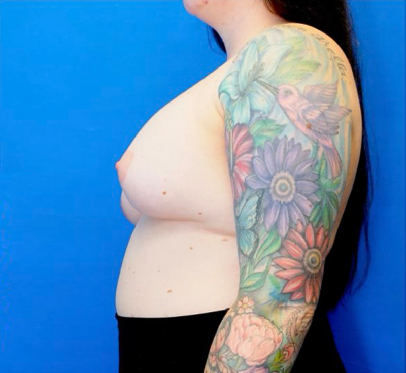Breast Implant Removal Before & After Photo