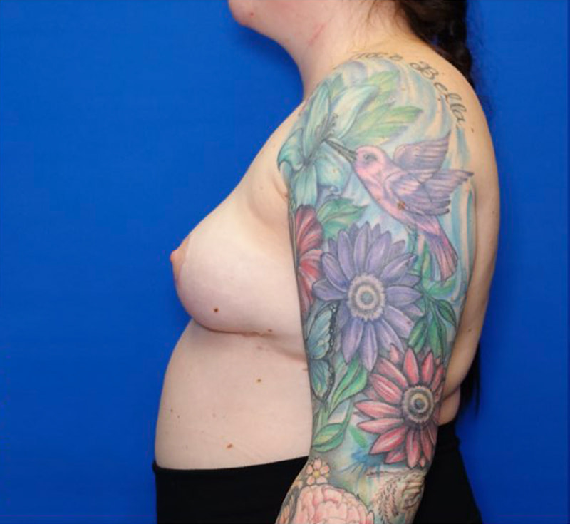 Breast Implant Removal Before & After Photo