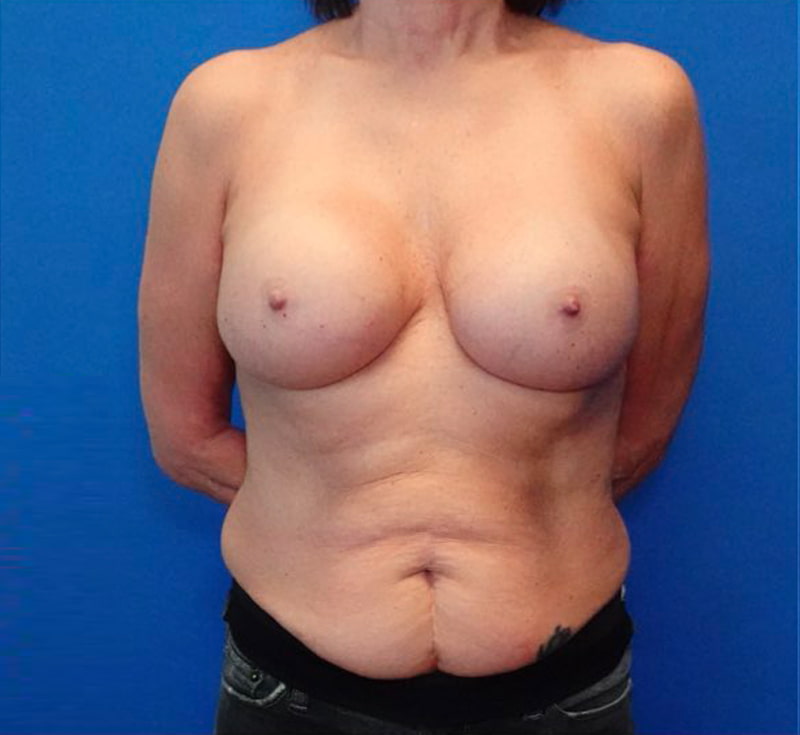 Breast Implant Removal Before & After Photo