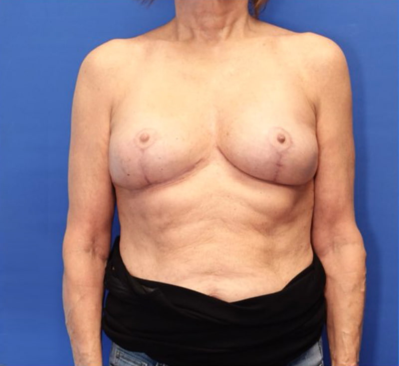 Breast Implant Removal Before & After Photo