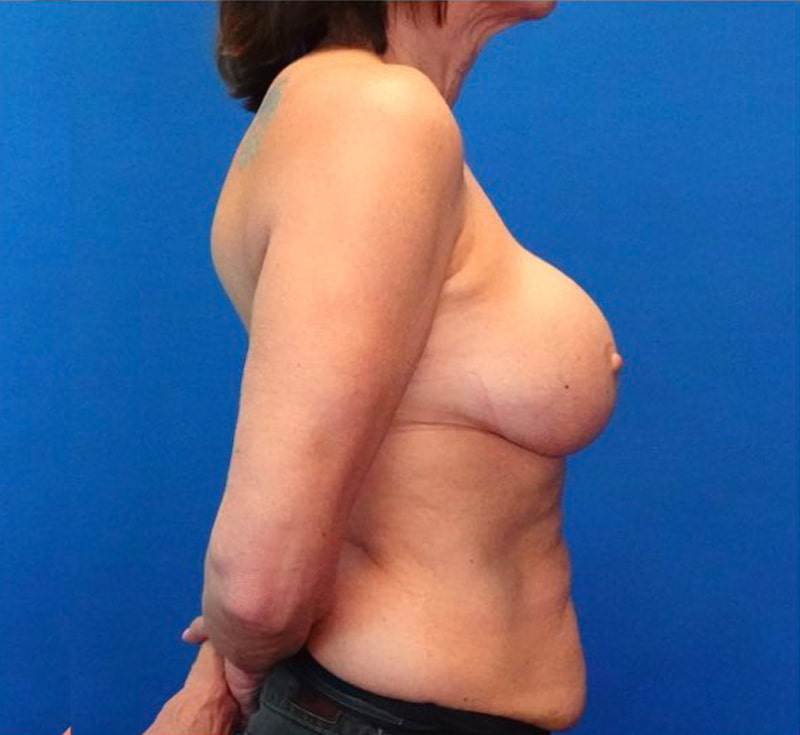 Breast Implant Removal Before & After Photo